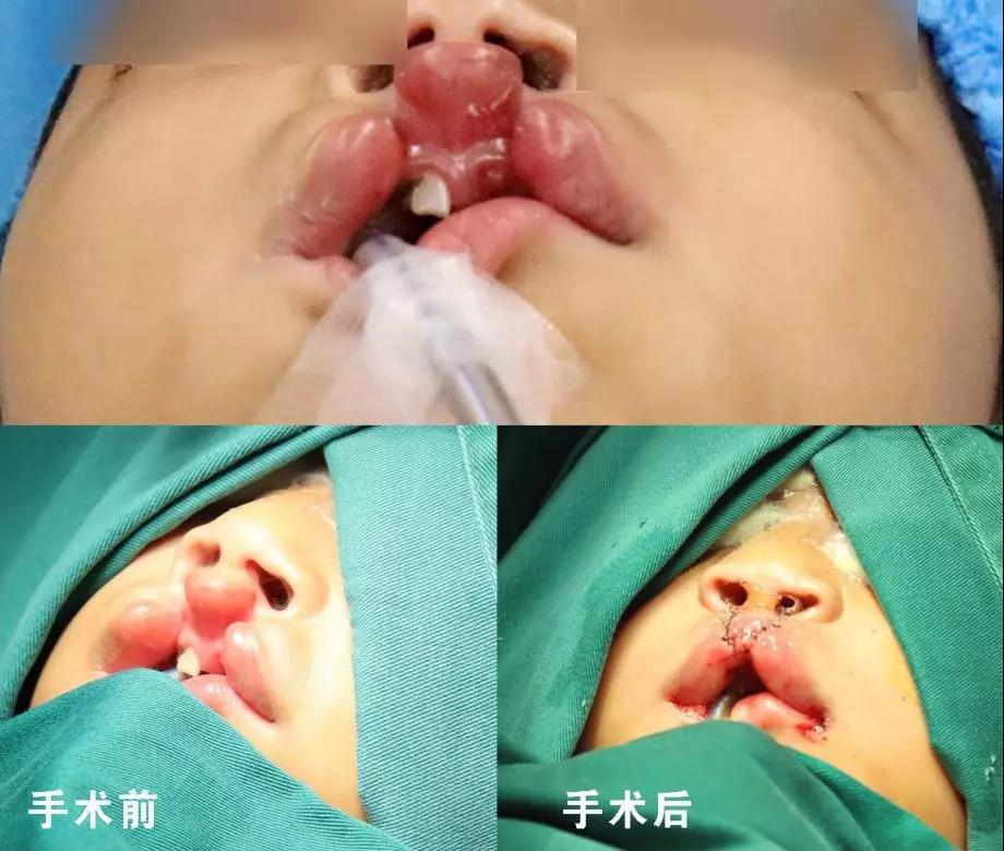 唇腭裂盡早治療消除孩子自卑心理，快樂成長！