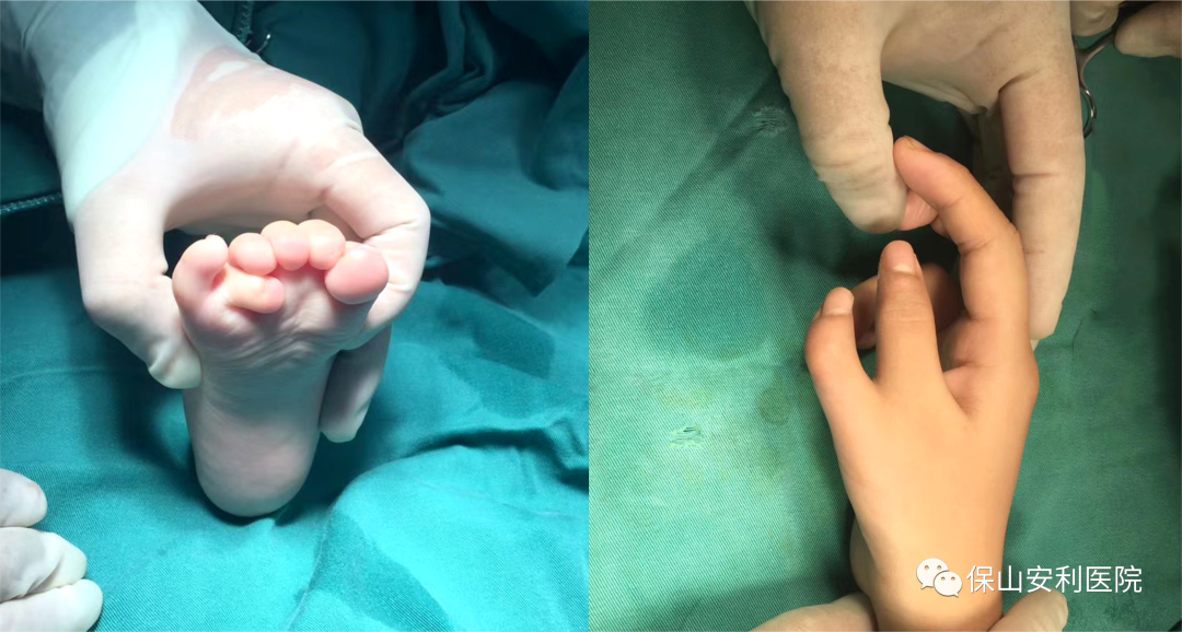 孩子先天手足多指（趾）不要慌，外二科幫你解除困擾！