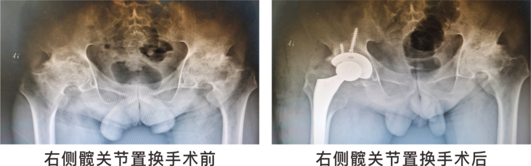 【保山安利醫(yī)院】長期飲酒導(dǎo)致雙側(cè)股骨頭壞死，髖關(guān)節(jié)置換后重獲運(yùn)動功能！