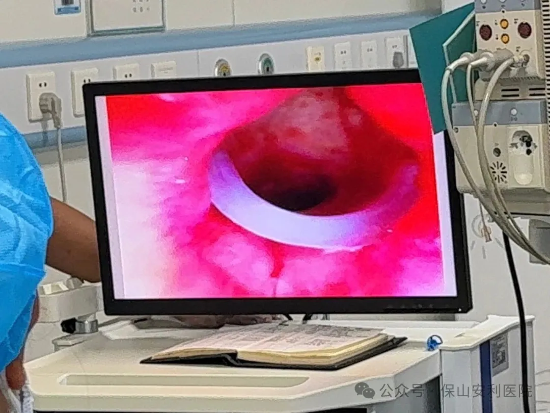 硬質(zhì)支氣管鏡下硅酮支架置入術(shù)-為氣道塌陷患者撐開生命通道