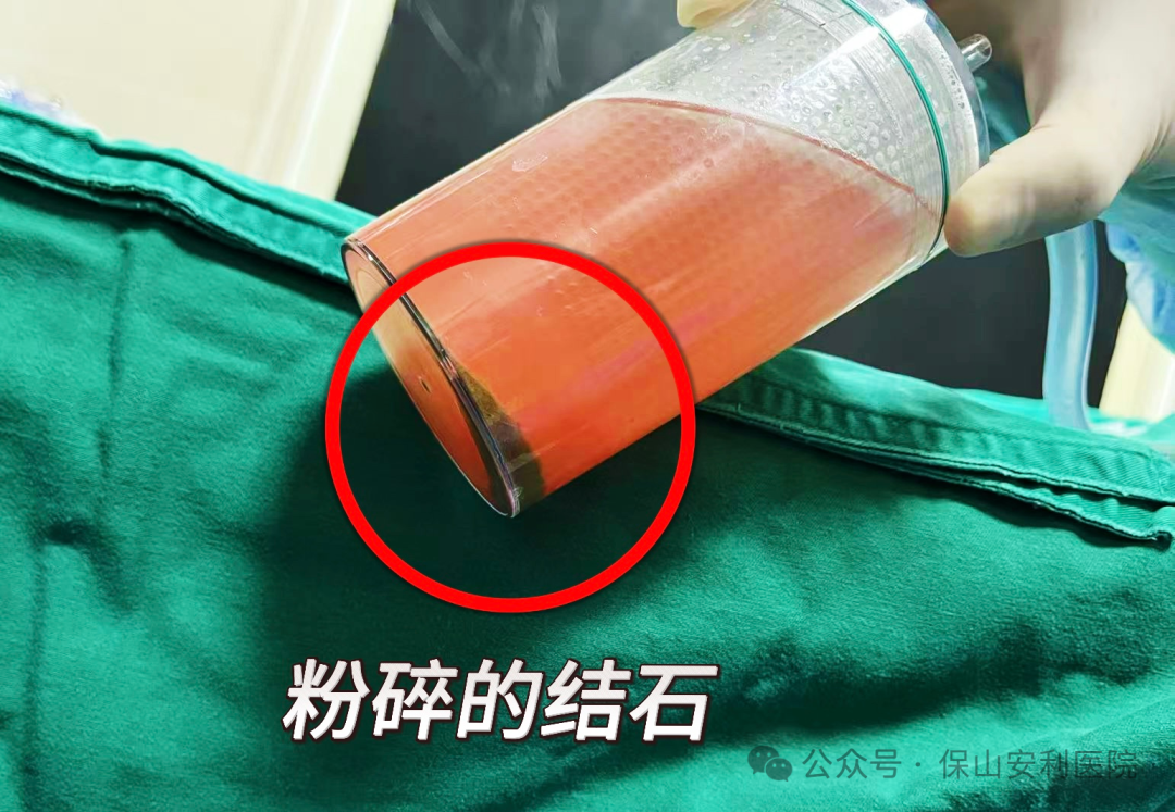 科普丨泌尿結(jié)石“克星”鈥激光碎石術(shù)，手術(shù)動圖揭秘全過程！